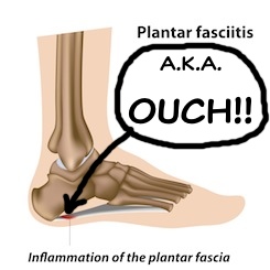 plantar-fasciitis